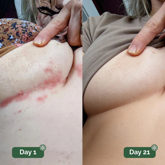 undercareskin